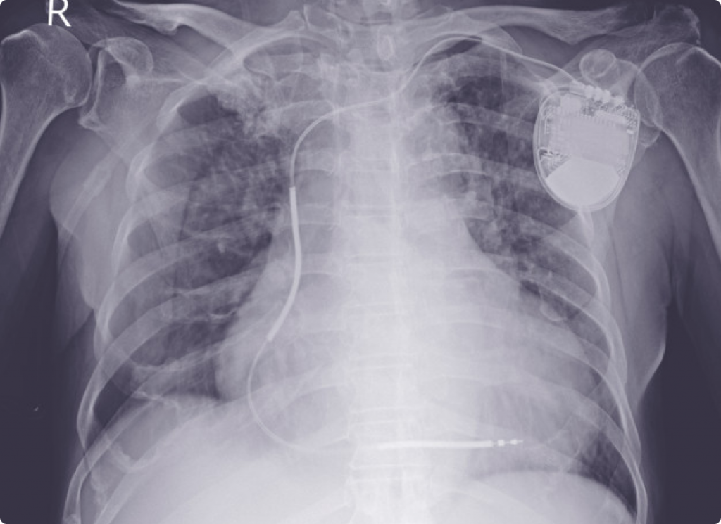 X-ray of an individual with a pacemaker